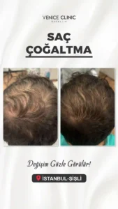 venıce oncesı sonras 2