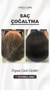 venıce oncesı sonras 3