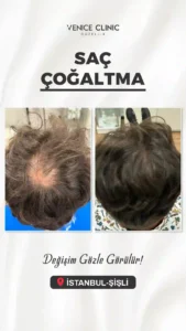 venıce oncesı sonrası 4