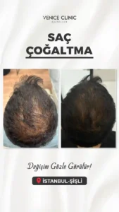 venıce oncesı sonrası5